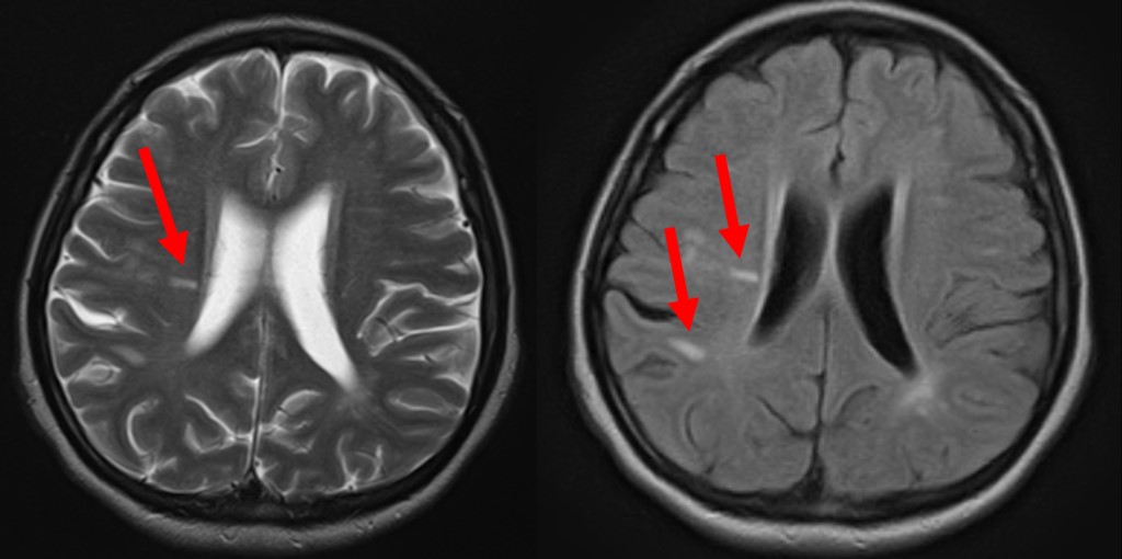 MS皮膚病変とは何ですか?