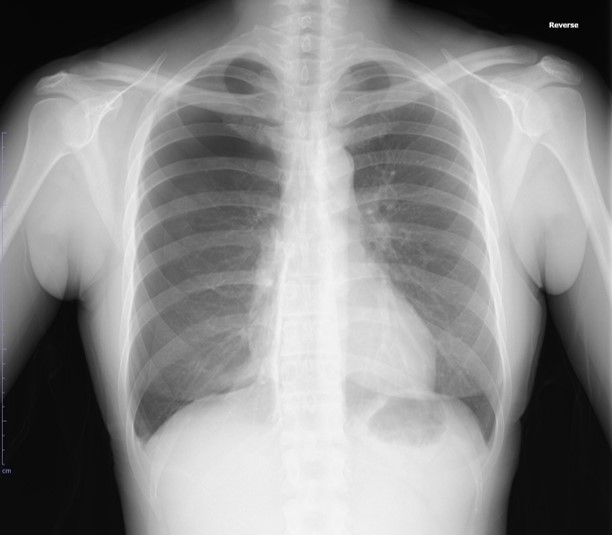 気胸の画像診断について|症状と治療 | Radiation Journal|医学部生や医療従事者のための画像診断、医療情報サイト
