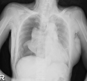 気胸の画像診断について|症状と治療 | Radiation Journal|医学部生や医療従事者のための画像診断、医療情報サイト