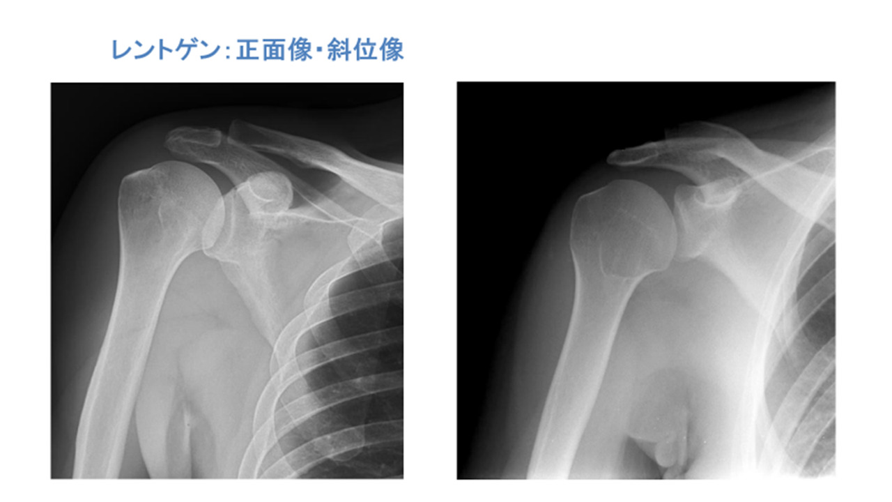 肩関節脱臼 | Radiation Journal|医学部生や医療従事者のための画像診断、医療情報サイト